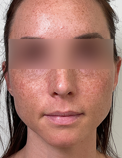 Sculptra — Midface Volume - After